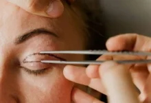 Blepharoplasty Surgeon