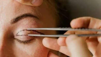 Blepharoplasty Surgeon