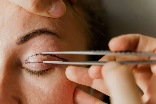Blepharoplasty Surgeon